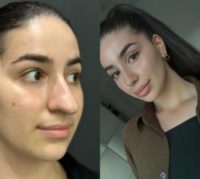 25-34 year old woman treated with Rhinoplasty, Septoplasty