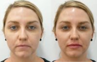 25-34 year old woman treated with Lip Augmentation