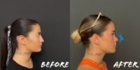 Woman treated with Rhinoplasty