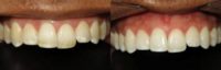17 or under year old man treated with Teeth Whitening