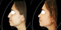 25-34 year old woman treated with Rhinoplasty