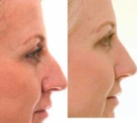 55-64 year old woman treated with Rhinoplasty