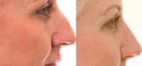 35-44 year old woman treated with Nose Surgery