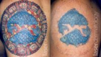 Tattoo Modification using Revlite QSY laser