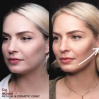 Cheek Bone Lift