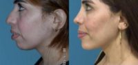25-34 year old woman treated with Rhinoplasty, Chin implant