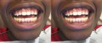 Laser Gum Lift for 15 year old; Immediate results