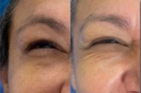 45-54 year old woman treated with Botox