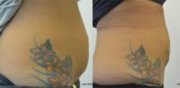 35-44 year old woman treated with Smart Lipo
