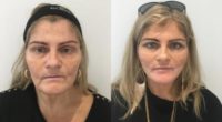 45-54 year old woman treated with Non Surgical Face Lift