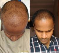 25-34 year old man treated with Hair Transplant