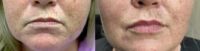 45-54 year old woman treated with Restylane