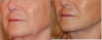 55-64 year old woman treated with Facelift