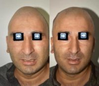 35-44 year old man treated with Facial Reconstructive Surgery