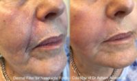 55-64 year old woman treated with Dermal Fillers, Ellanse