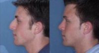 25-34 year old man treated with Rhinoplasty