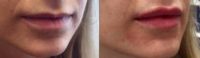 25-34 year old woman treated with Juvederm Ultra Plus in the Lips.