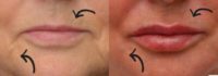 Woman treated with Dermal Fillers