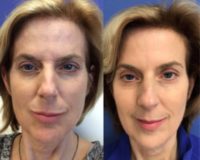 53 year old woman treated with Botox
