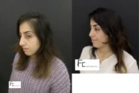 18-24 year old woman treated with Rhinoplasty