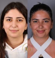 Woman treated with Rhinoplasty