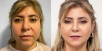 45-54 year old woman treated with SMAS Facelift