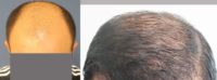 25-34 year old man treated with Hair Loss Treatment