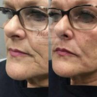 Woman treated with Dermal Fillers