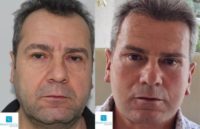 35-44 year old man treated with Facelift