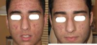 18-24 year old man treated for Acne Treatment