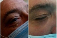 55-64 year old man treated with Laser Resurfacing