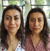 35-44 year old woman after Botox injections