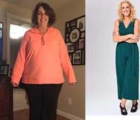 Woman treated with Gastric Sleeve Surgery