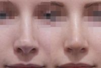 25-34 year old woman treated with Revision Rhinoplasty