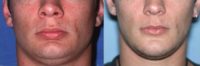 Before/After Genioplasty (Chin Surgery)