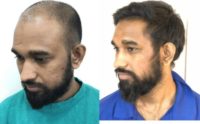 25-34 year old man treated with FUE Hair Transplant