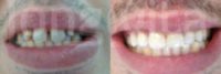 18-24 year old man treated with Porcelain Veneers