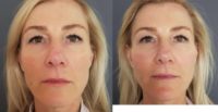 45-54 year old woman treated with Juvederm