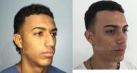 18-24 year old man treated with Rhinoplasty