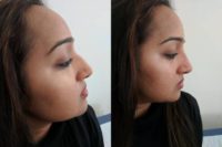 18-24 year old woman treated with Non Surgical Nose Job