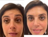 Woman treated with Botox
