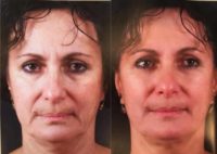 55-64 year old woman treated with Exilis 4 times