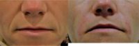 35-44 year old woman treated with Injectable Fillers to nasolabial area