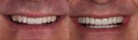 55-64 year old man treated with a 28 unit Smile Makeover