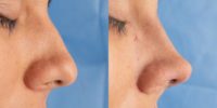 25-34 year old woman treated with Rhinoplasty