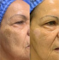 55-64 year old woman treated with Botox