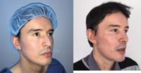 35-44 year old man treated with Rhinoplasty