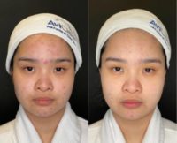 25-34 year old woman treated with AviClear