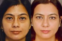 Middle-aged woman treated for lower Eye Bags with Scarless Blepharoplasty