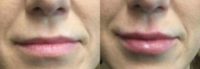 35-44 year old woman treated with Lip Augmentation